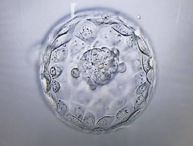 桂北首例 广西壮族自治区南溪山医院助卵子冷冻患者成功获得妊娠