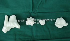 南溪山医院完成广西首例定制化人工踝关节置换